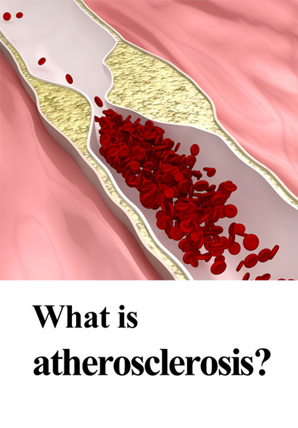 What is atherosclerosis?