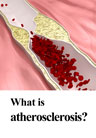 What is atherosclerosis?